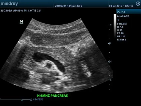 Клинические изображения УЗИ аппарат Mindray DC-N2