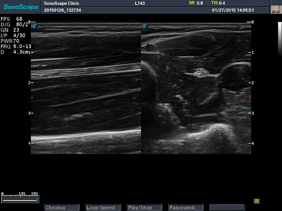 Клинические изображения Sonoscape S8 Exp ультразвуковой аппарат