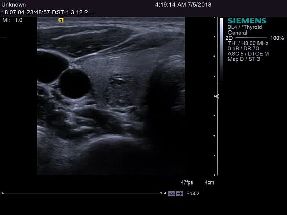 Клинические изображения Siemens ACUSON S2000 ультразвуковая система