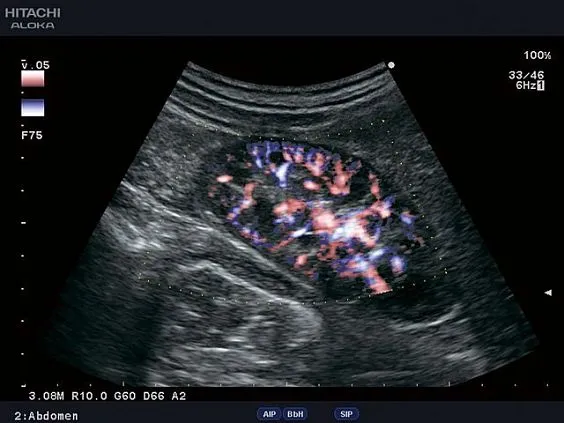 Клинические изображения УЗИ аппарат Fujifilm (Hitachi) Aloka ProSound F31