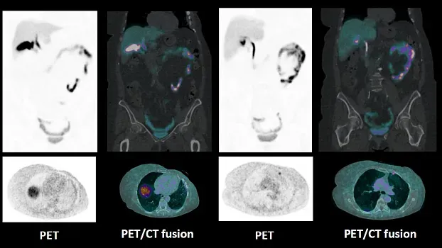 Клинические изображения Siemens Biograph Vision ПЭТ-КТ