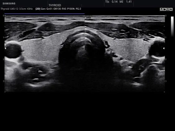 Клинические изображения Samsung Medison HS30 УЗИ аппарат