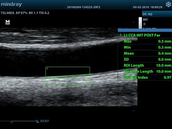 Клинические изображения УЗИ аппарат Mindray DC-N2