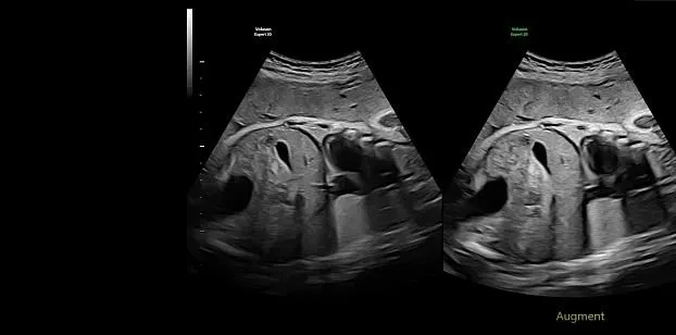 Клинические изображения УЗИ аппарат GE HealthCare Voluson Expert 20