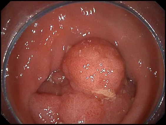 Клинические изображения SonoScape HD-350 видеоэндоскопическая система