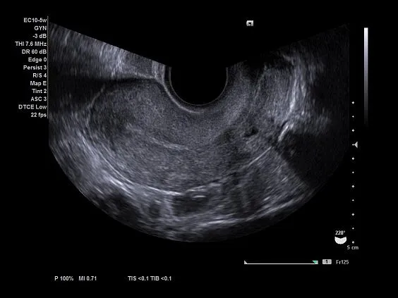 Клинические изображения Ультразвуковая система Siemens Acuson NX3