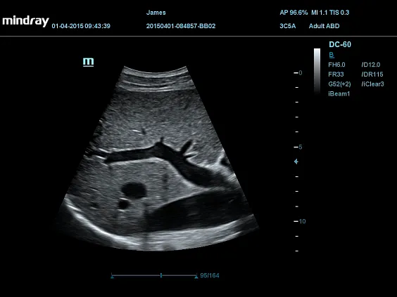 Клинические изображения УЗИ аппарат Mindray DC-60 Pro X-Insight