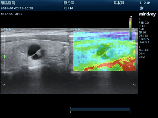Клинические изображения УЗИ аппарат Mindray M9 портативный