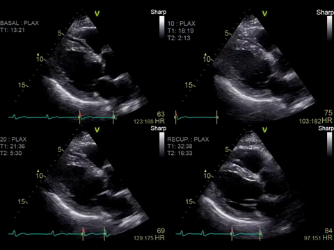 Клинические изображения Ультразвуковая диагностическая система GE Vivid S60