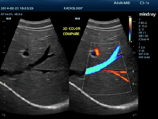 Клинические изображения УЗИ аппарат Mindray M9 портативный