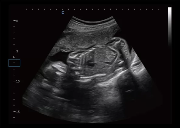 Клинические изображения УЗИ аппарат Chison CBit 4