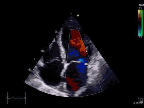 Клинические изображения Ультразвуковая диагностическая система GE Vivid S60