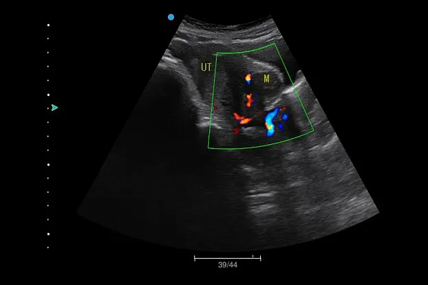 Клинические изображения SIUI Apogee 5300 аппарат УЗИ