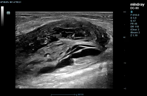 Клинические изображения УЗИ аппарат Mindray DC-90 Exp
