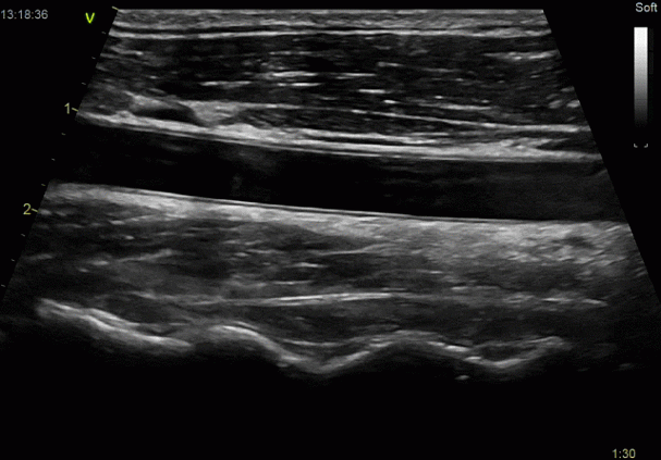 Клинические изображения УЗИ аппарат GE HealthCareVivid E90