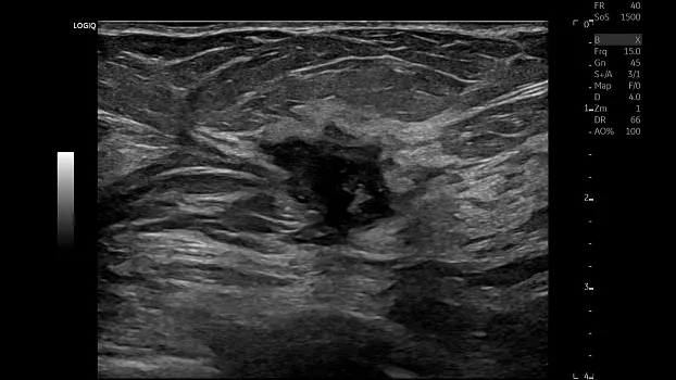 Клинические изображения GE HealthCare Logiq E10 ультразвуковая система