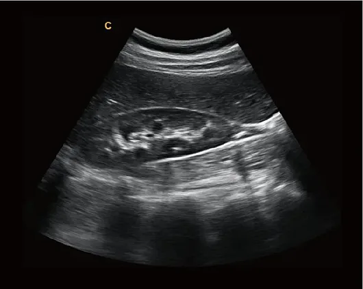 Клинические изображения Chison i9 ультразвуковой аппарат