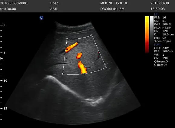 Клинические изображения УЗИ аппарат Chison Qbit 5