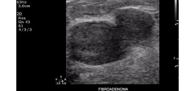 Клинические изображения Philips ClearVue 350 ультразвуковой аппарат