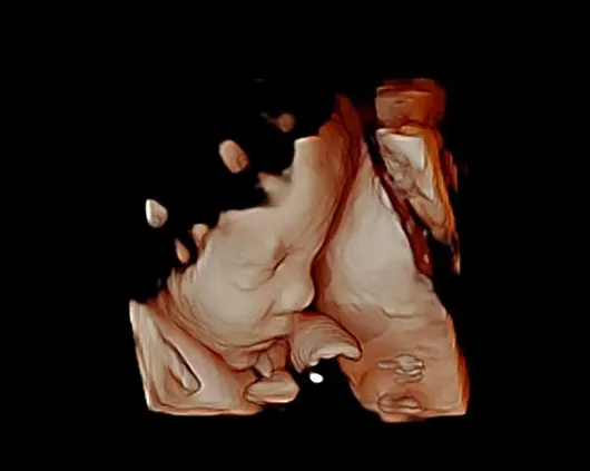 Клинические изображения УЗИ аппарат Chison Qbit 8