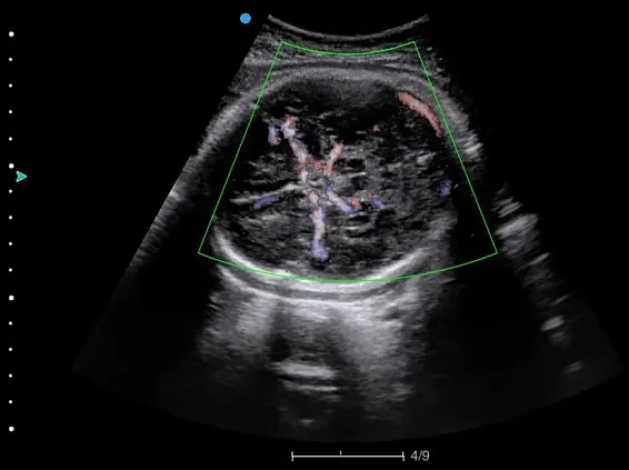 Клинические изображения УЗИ аппарат SIUI Apogee 5800