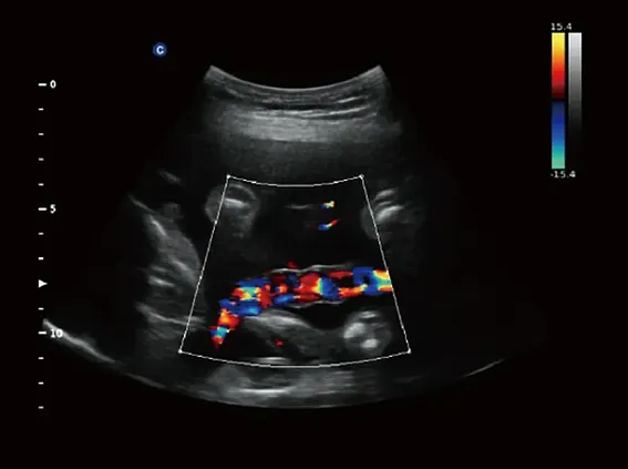 Клинические изображения Chison Qbit 3 аппарат УЗИ