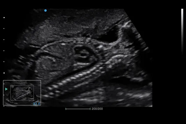 Клинические изображения SIUI Apogee 5300 аппарат УЗИ