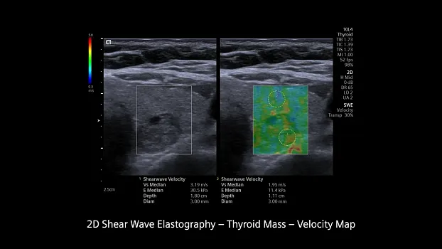 Клинические изображения Siemens Redwood аппарат УЗИ