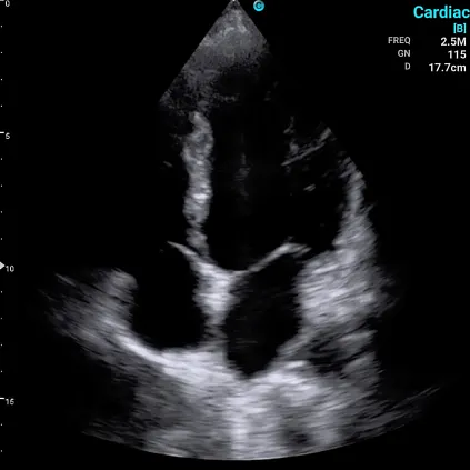 Клинические изображения Chison Sonotouch 30 (Sonoeye) портативный УЗИ аппарат