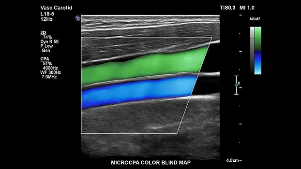 Клинические изображения Philips EPIQ Elite ультразвуковой аппарат
