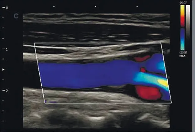 Клинические изображения УЗИ аппарат Chison Qbit 11