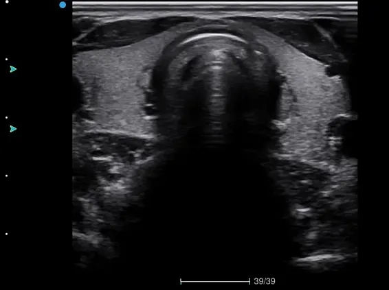 Клинические изображения УЗИ аппарат SIUI Apogee 5800