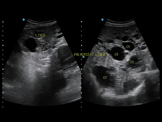 Клинические изображения Аппарат УЗИ SIUI Apogee 5500