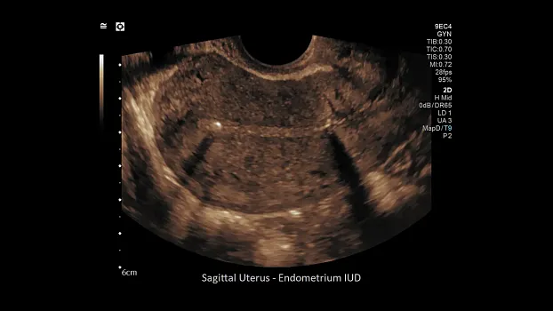 Клинические изображения Siemens Sequoia аппарат УЗИ
