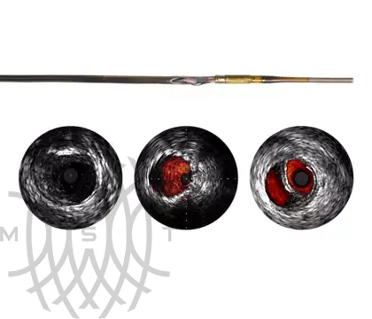 Philips Visions PV (0,018 дюйма) катетер ротационный