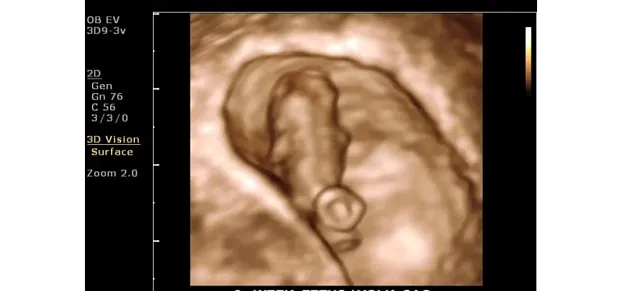 Клинические изображения Philips ClearVue 650 ультразвуковой аппарат