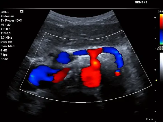 Клинические изображения Siemens Acuson P500 портативный аппарат УЗИ