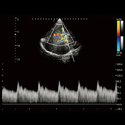 Клинические изображения УЗИ аппарат Chison Qbit 10