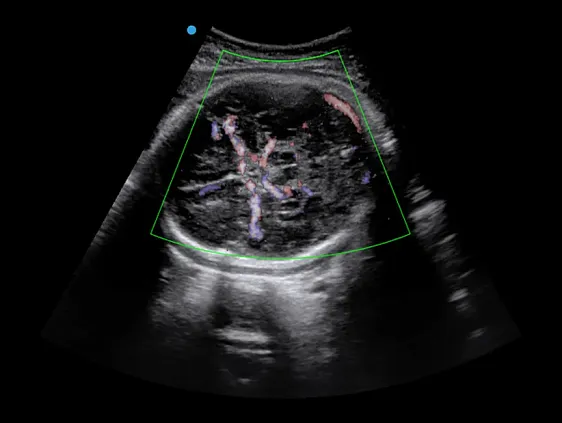 Клинические изображения Аппарат УЗИ SIUI Apogee 5500