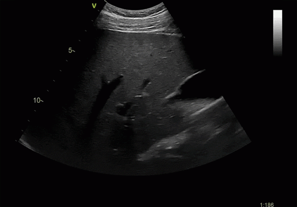 Клинические изображения УЗИ аппарат GE HealthCareVivid E90