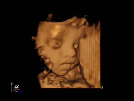 Клинические изображения Аппарат УЗИ SIUI Apogee 5500