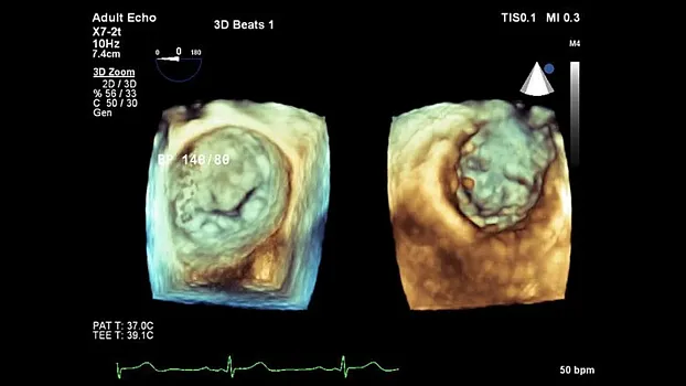 Клинические изображения Philips EPIQ Elite ультразвуковой аппарат