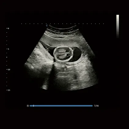 Клинические изображения Chison Qbit 12 ультразвуковой аппарат