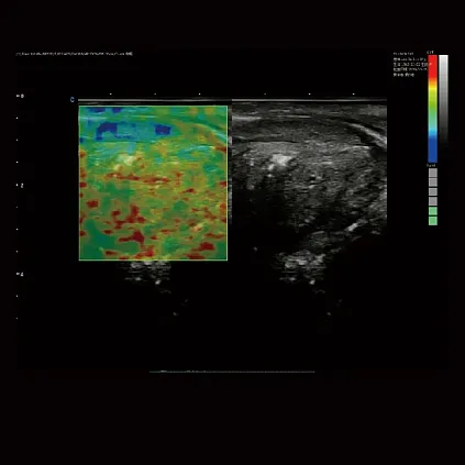 Клинические изображения Chison Qbit 12 ультразвуковой аппарат