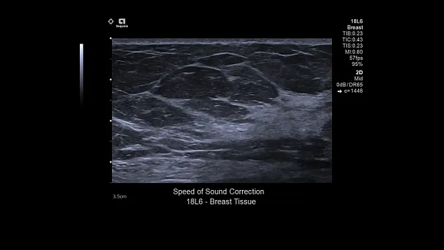 Клинические изображения Siemens Sequoia аппарат УЗИ
