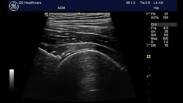 Клинические изображения Портативная ультразвуковая система GE HealthCare Logiq e