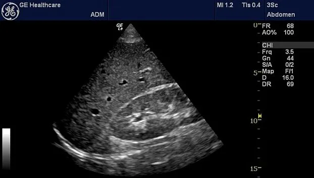 Клинические изображения Портативная ультразвуковая система GE HealthCare Logiq e
